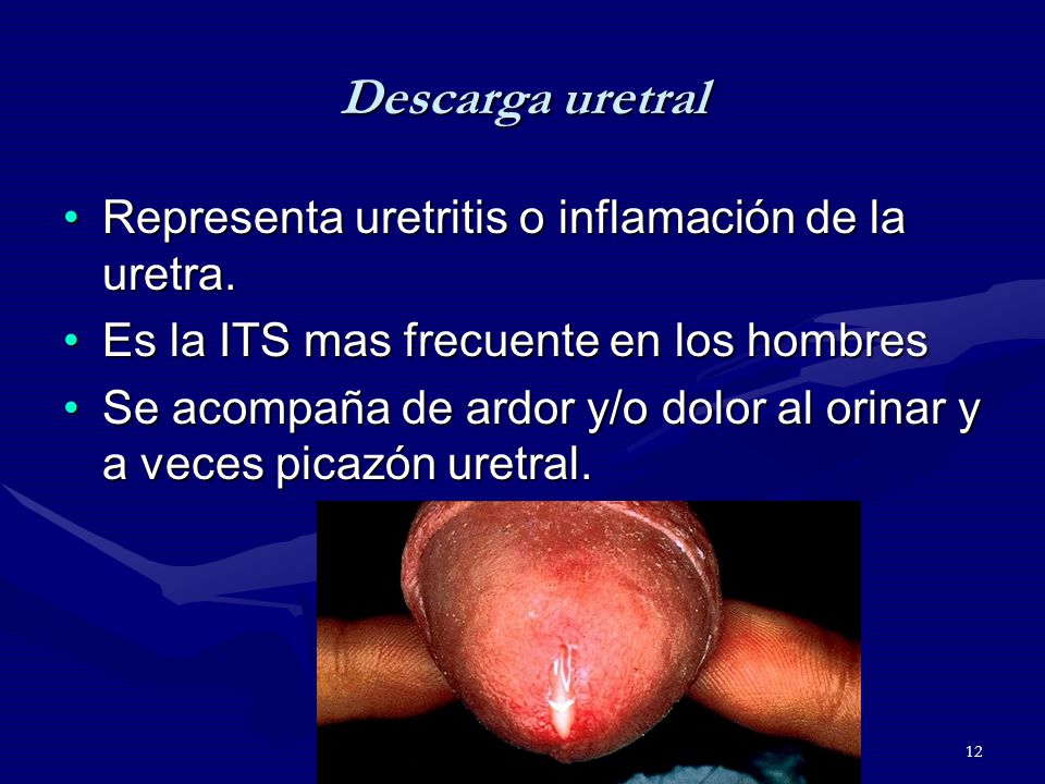 hombres de inflamación de la uretra
